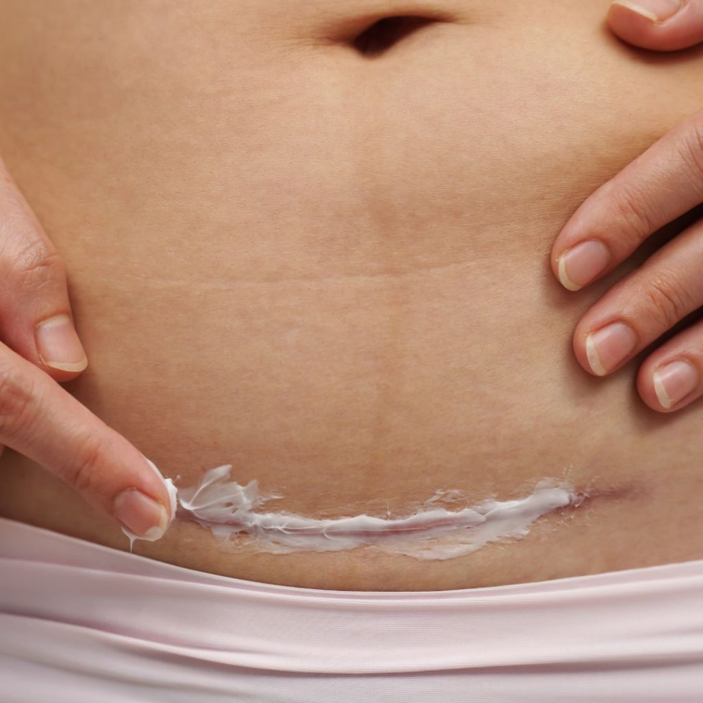 A healing C-section scar at 6 weeks postpartum. While the external incision may appear healed, internal healing and core recovery continue well beyond this point. A 6 week postpartum physio check can help assess abdominal function, scar sensitivity, and guide your return to safe movement.