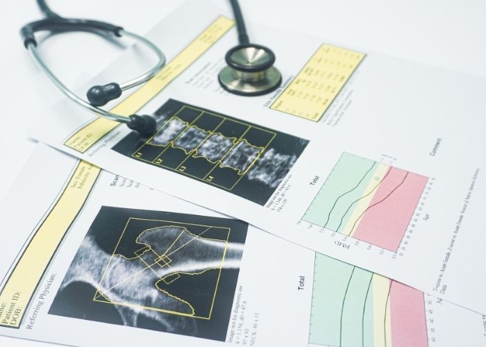 Featured image for “Bone Density Scan: What It Is, Who Needs One, and Why It Matters 🦴”