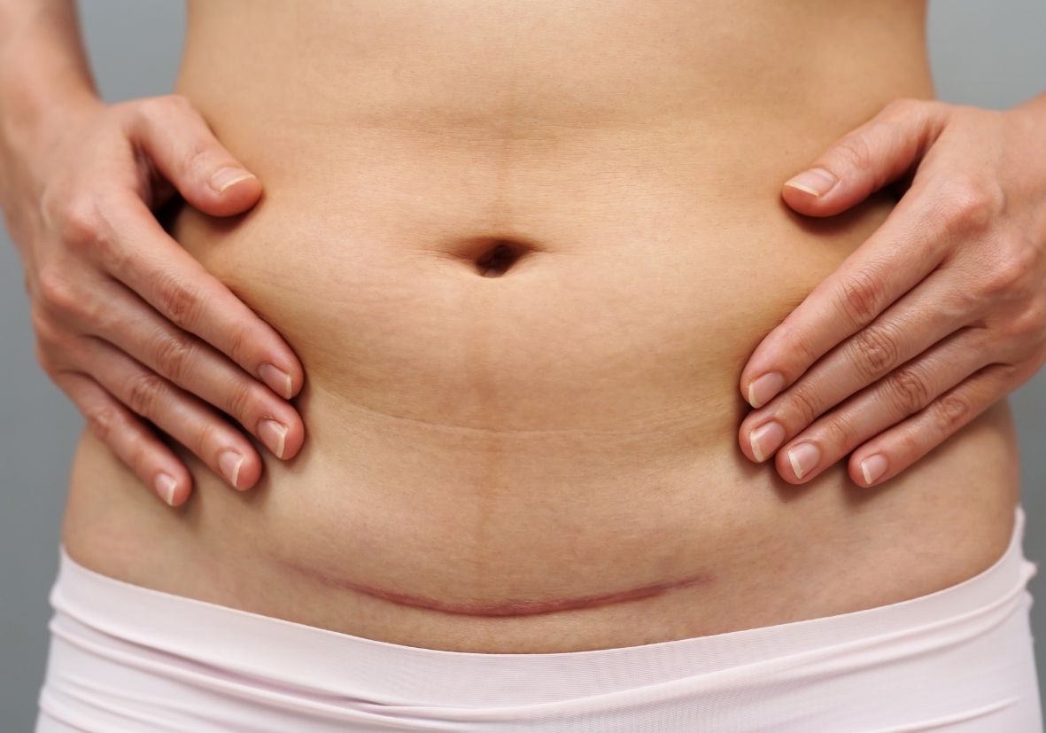 C-section recovery is more than healing a scar. It’s about rebuilding your deep core, supporting your pelvic floor, and returning to movement with confidence and care.